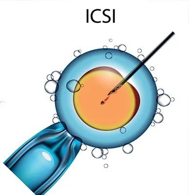 Intra Cytoplasmic Sperm Injection